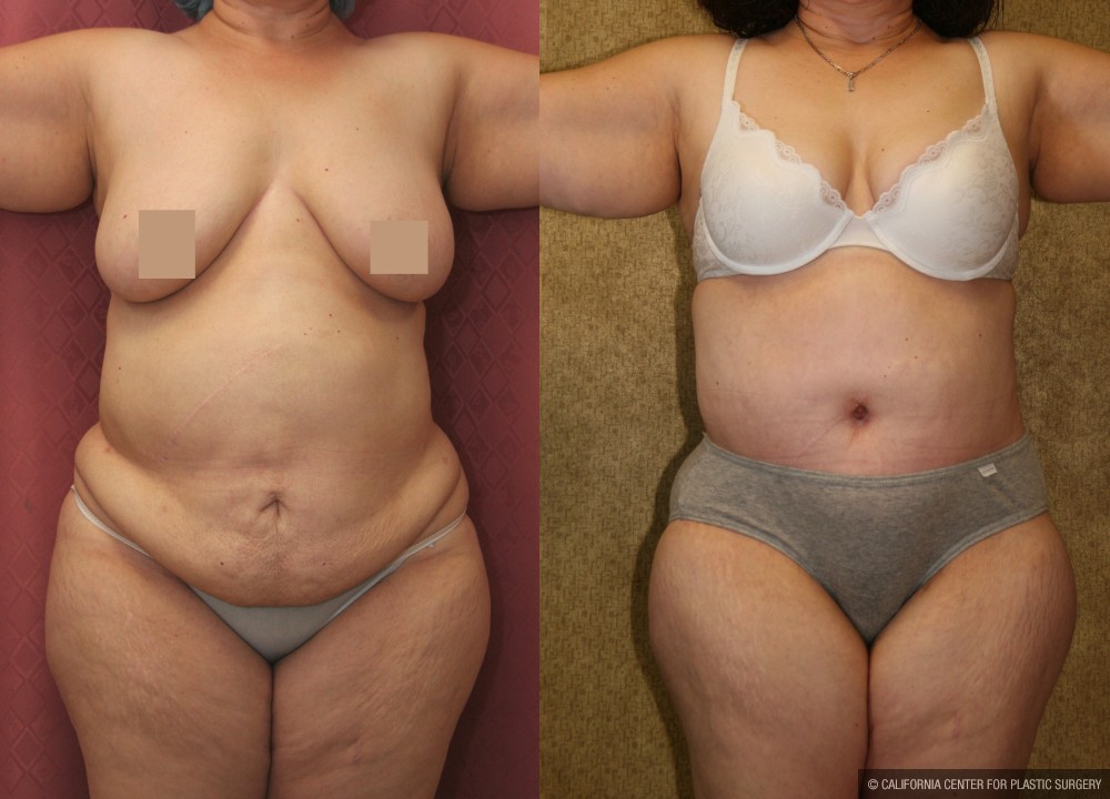 Tummy Tuck (Abdominoplasty) Super Plus Size Before & After Patient #12693