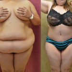 Tummy Tuck (Abdominoplasty) Super Plus Size Before & After Patient #12721