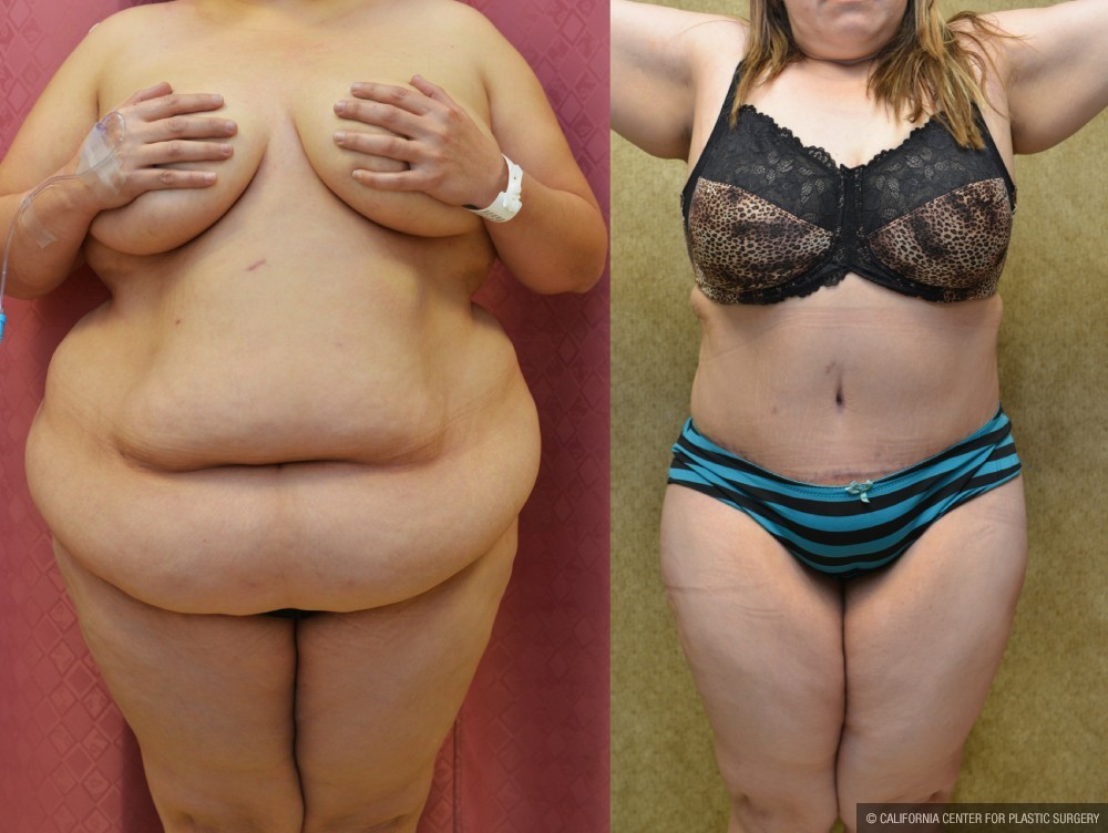 Tummy Tuck (Abdominoplasty) Super Plus Size Before & After Patient #12721