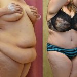 Tummy Tuck (Abdominoplasty) Super Plus Size Before & After Patient #12721