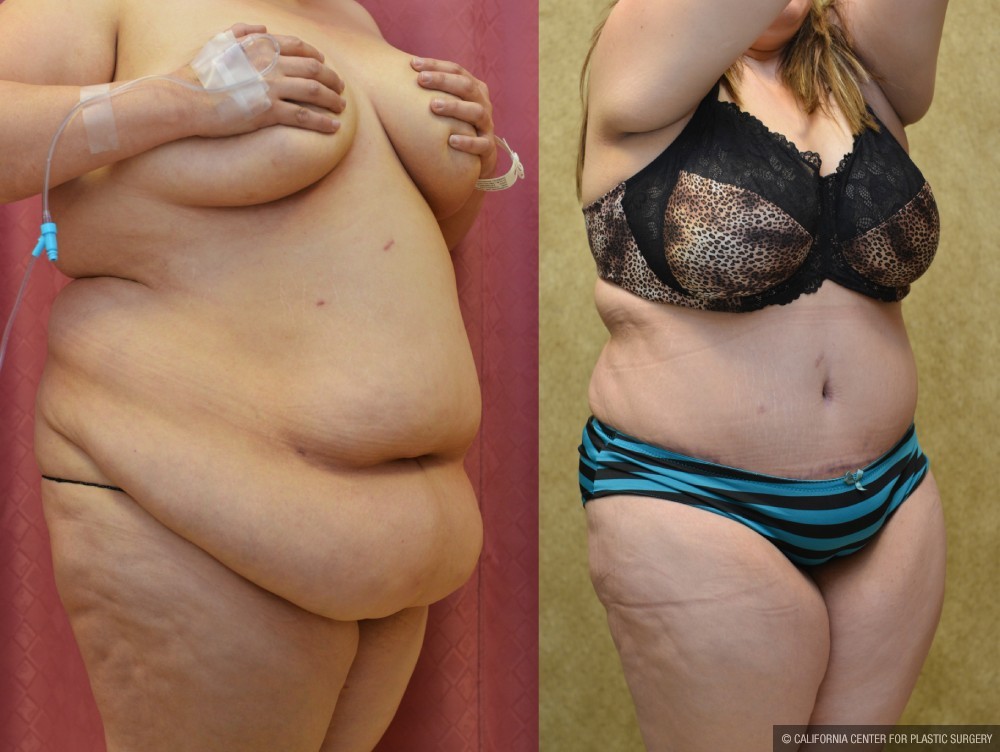 Tummy Tuck (Abdominoplasty) Super Plus Size Before & After Patient #12721