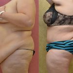 Tummy Tuck (Abdominoplasty) Super Plus Size Before & After Patient #12721