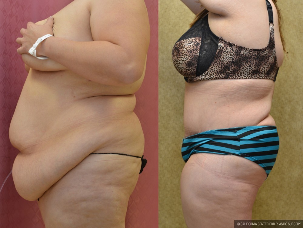 Tummy Tuck (Abdominoplasty) Super Plus Size Before & After Patient #12721