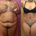 Tummy Tuck (Abdominoplasty) Super Plus Size Before & After Patient #12725