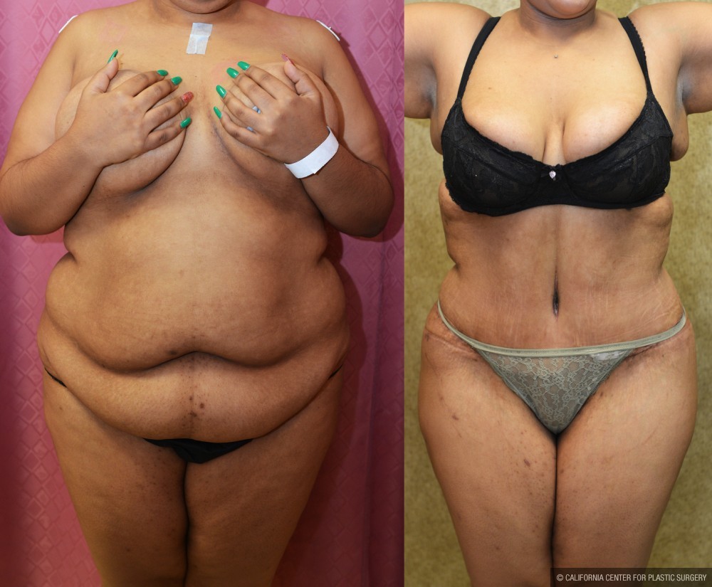 Tummy Tuck (Abdominoplasty) Super Plus Size Before & After Patient #12725