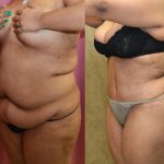 Tummy Tuck (Abdominoplasty) Super Plus Size Before & After Patient #12725