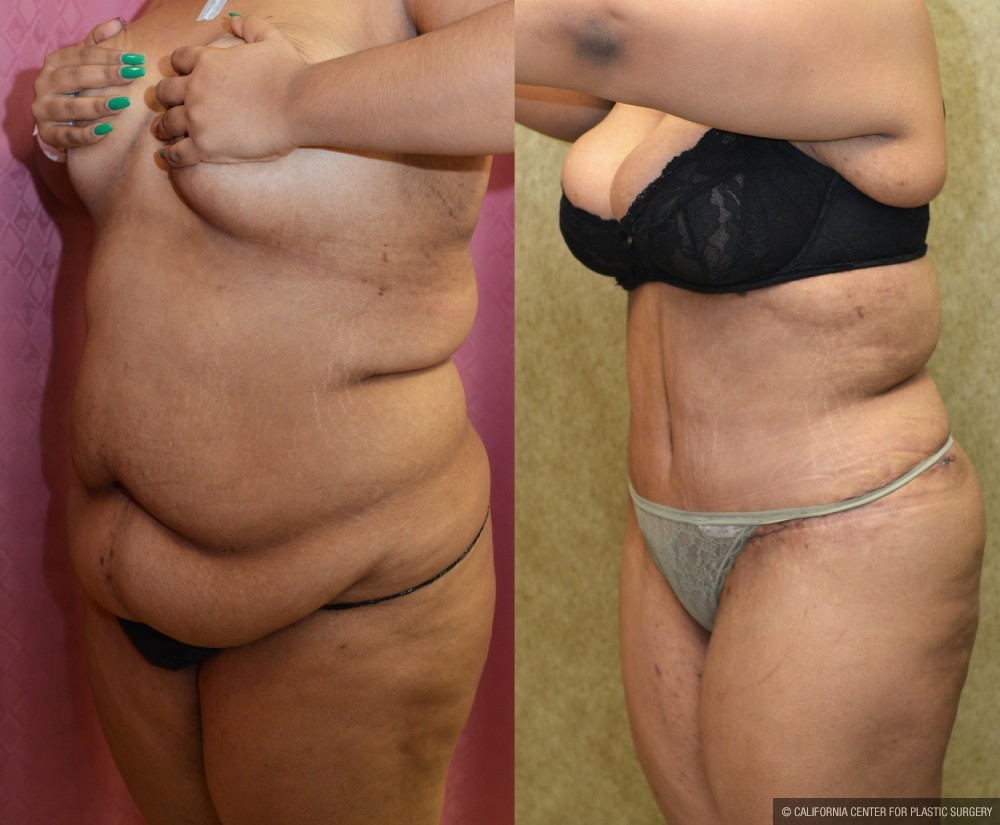 Tummy Tuck (Abdominoplasty) Super Plus Size Before & After Patient #12725