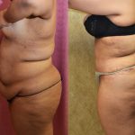 Tummy Tuck (Abdominoplasty) Super Plus Size Before & After Patient #12725