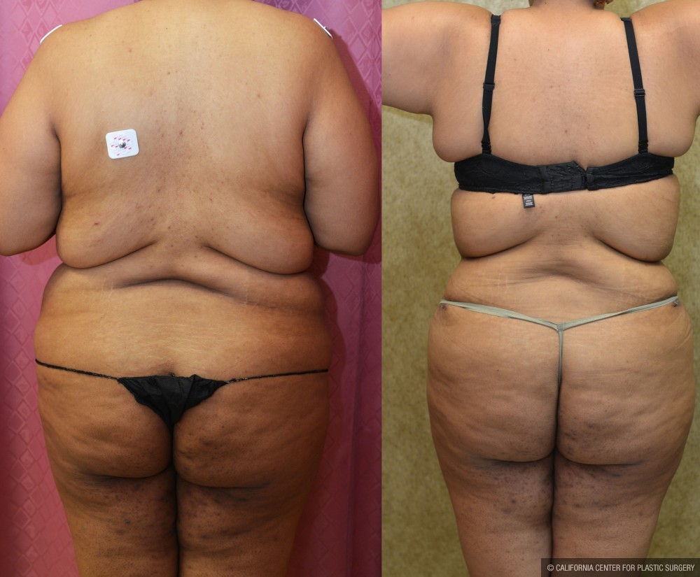 Tummy Tuck (Abdominoplasty) Super Plus Size Before & After Patient #12725