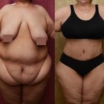 Tummy Tuck (Abdominoplasty) Super Plus Size Before & After Patient #12730