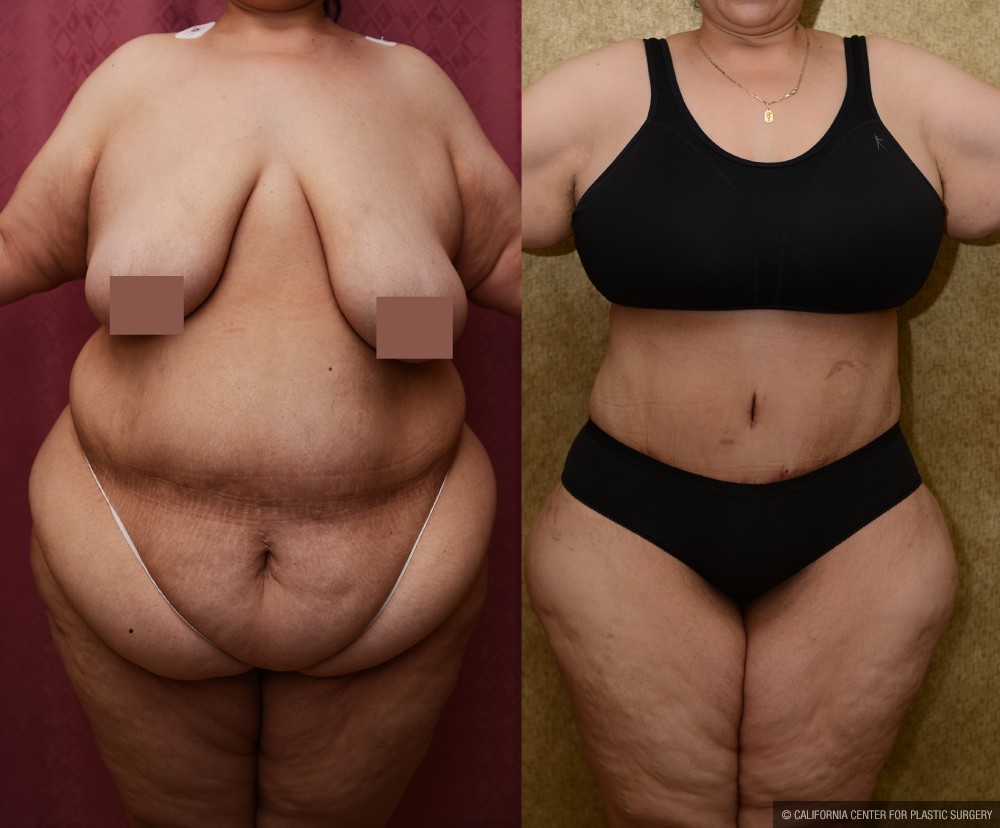 Tummy Tuck (Abdominoplasty) Super Plus Size Before & After Patient #12730