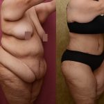 Tummy Tuck (Abdominoplasty) Super Plus Size Before & After Patient #12730