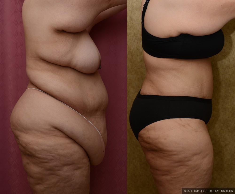 Tummy Tuck (Abdominoplasty) Super Plus Size Before & After Patient #12730