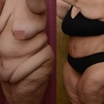 Tummy Tuck (Abdominoplasty) Super Plus Size Before & After Patient #12730