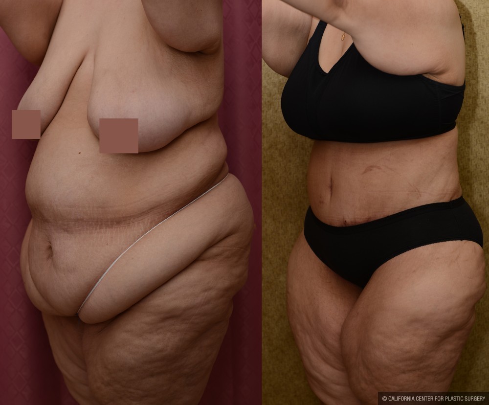 Tummy Tuck (Abdominoplasty) Super Plus Size Before & After Patient #12730