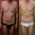 Male Tummy Tuck (abdominoplasty) Before & After Patient #12650