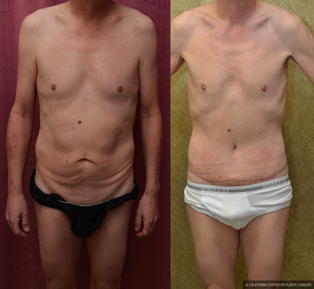 Male Tummy Tuck (abdominoplasty) Before & After Patient #12650