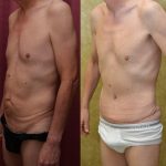 Male Tummy Tuck (abdominoplasty) Before & After Patient #12650