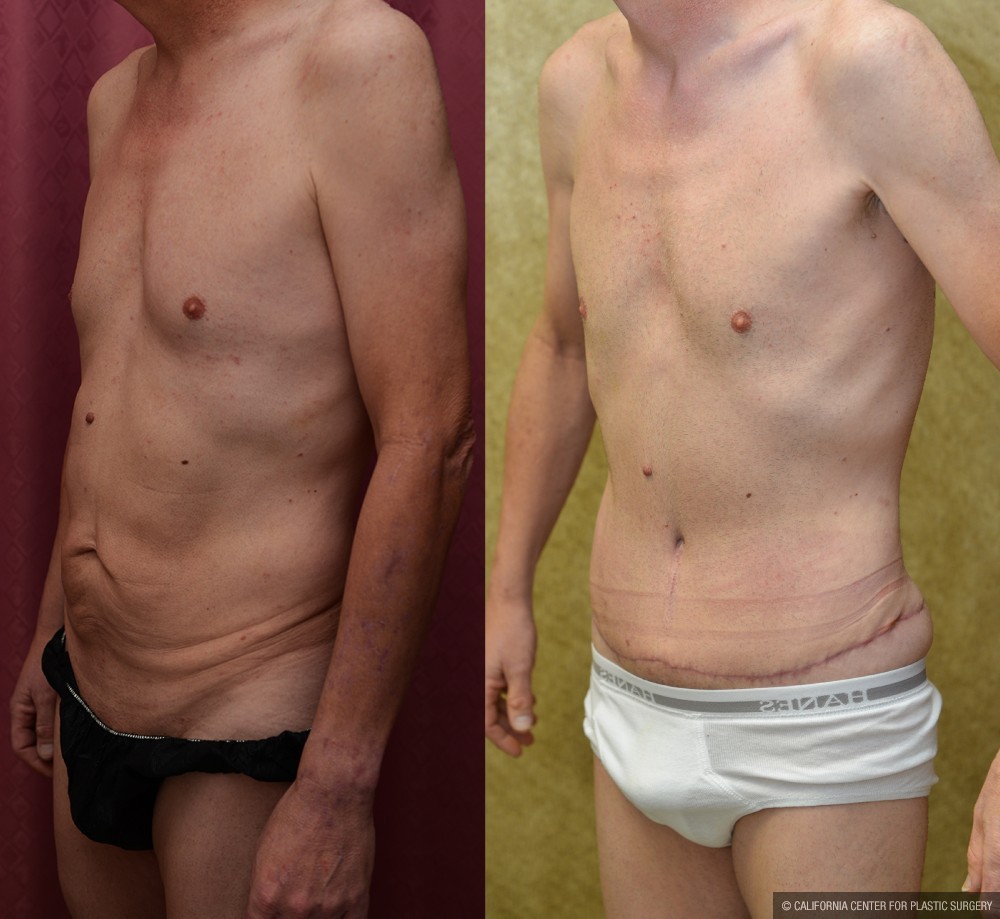 Male Tummy Tuck (abdominoplasty) Before & After Patient #12650