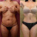 Tummy Tuck (Abdominoplasty) Medium Size Before & After Patient #12642