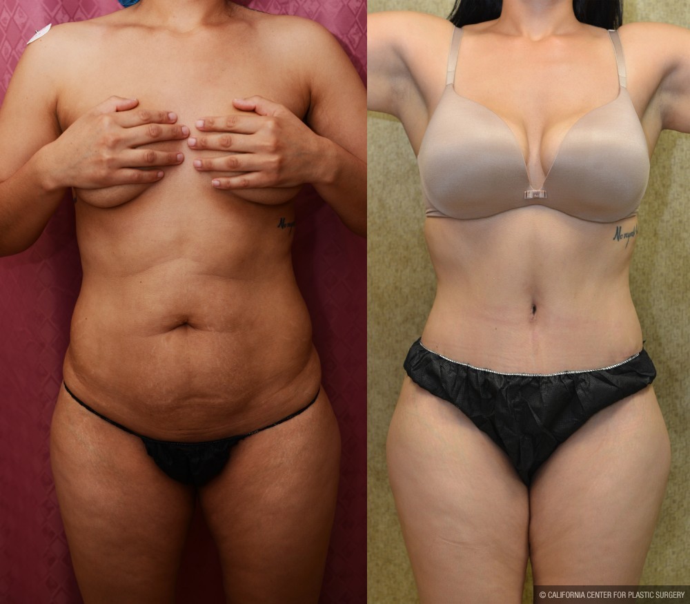 Tummy Tuck (Abdominoplasty) Medium Size Before & After Patient #12642