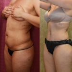 Tummy Tuck (Abdominoplasty) Medium Size Before & After Patient #12642