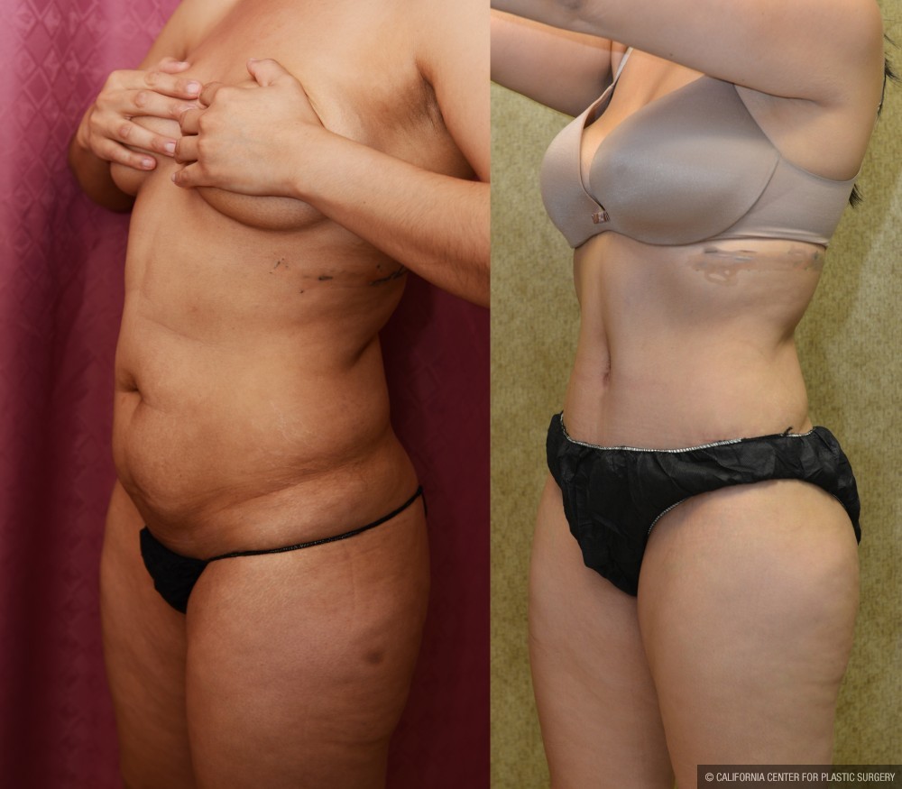 Tummy Tuck (Abdominoplasty) Medium Size Before & After Patient #12642