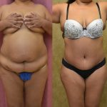 Tummy Tuck (Abdominoplasty) Medium Size Before & After Patient #12630
