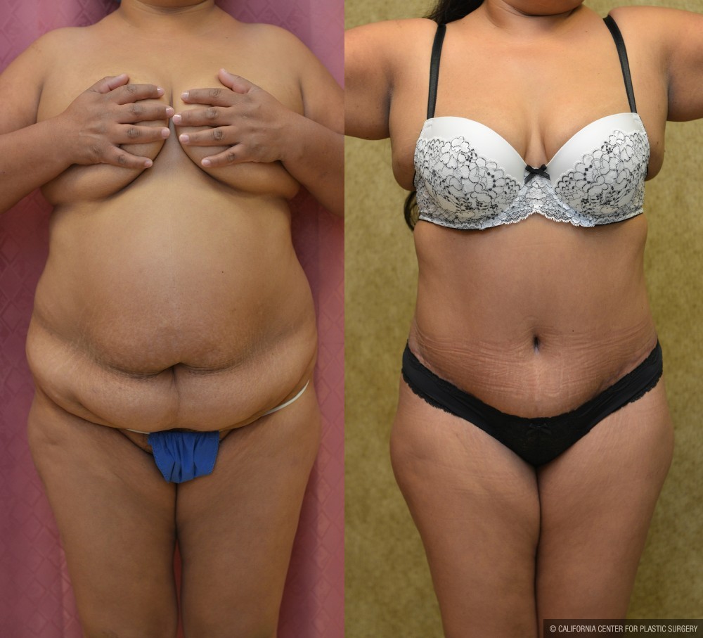 Tummy Tuck (Abdominoplasty) Medium Size Before & After Patient #12630