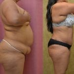 Tummy Tuck (Abdominoplasty) Medium Size Before & After Patient #12630