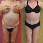 Tummy Tuck (Abdominoplasty) Medium Size Before & After Patient #12635