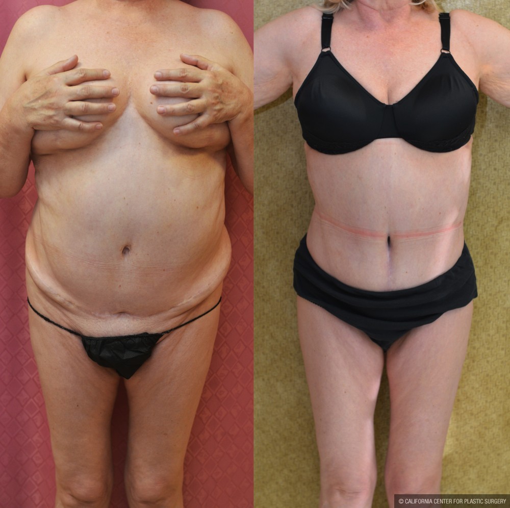 Tummy Tuck (Abdominoplasty) Medium Size Before & After Patient #12635