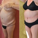 Tummy Tuck (Abdominoplasty) Medium Size Before & After Patient #12635