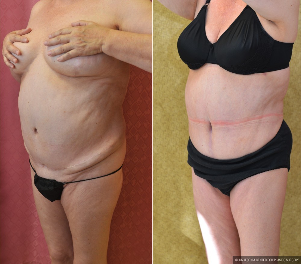 Tummy Tuck (Abdominoplasty) Medium Size Before & After Patient #12635