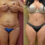 Tummy Tuck (Abdominoplasty) Medium Size Before & After Patient #12638