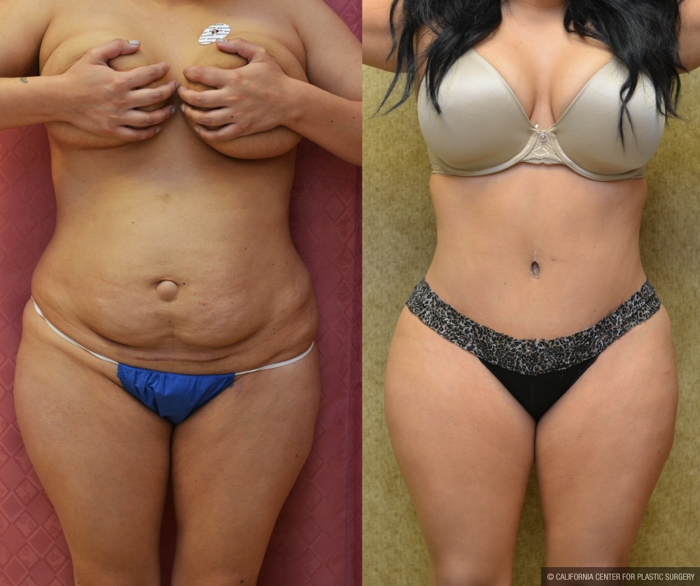 Tummy Tuck (Abdominoplasty) Medium Size Before & After Patient #12638