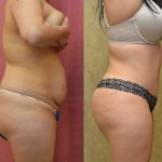 Tummy Tuck (Abdominoplasty) Medium Size Before & After Patient #12638