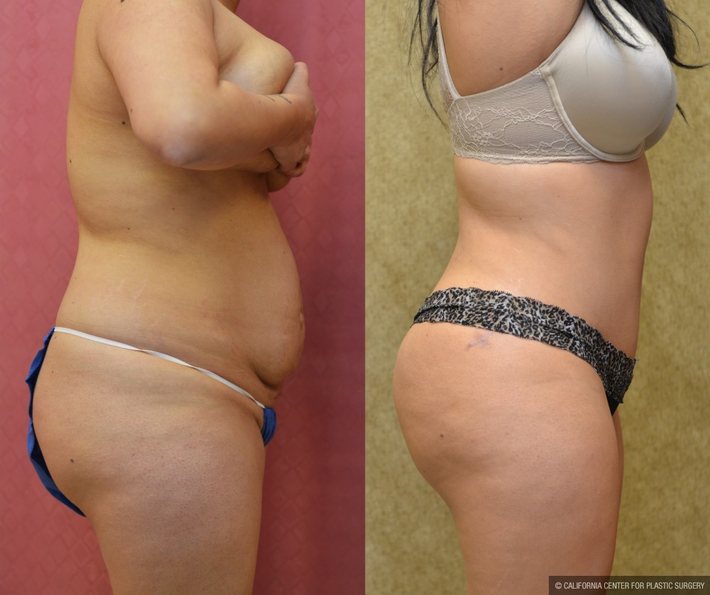 Tummy Tuck (Abdominoplasty) Medium Size Before & After Patient #12638