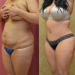 Tummy Tuck (Abdominoplasty) Medium Size Before & After Patient #12638