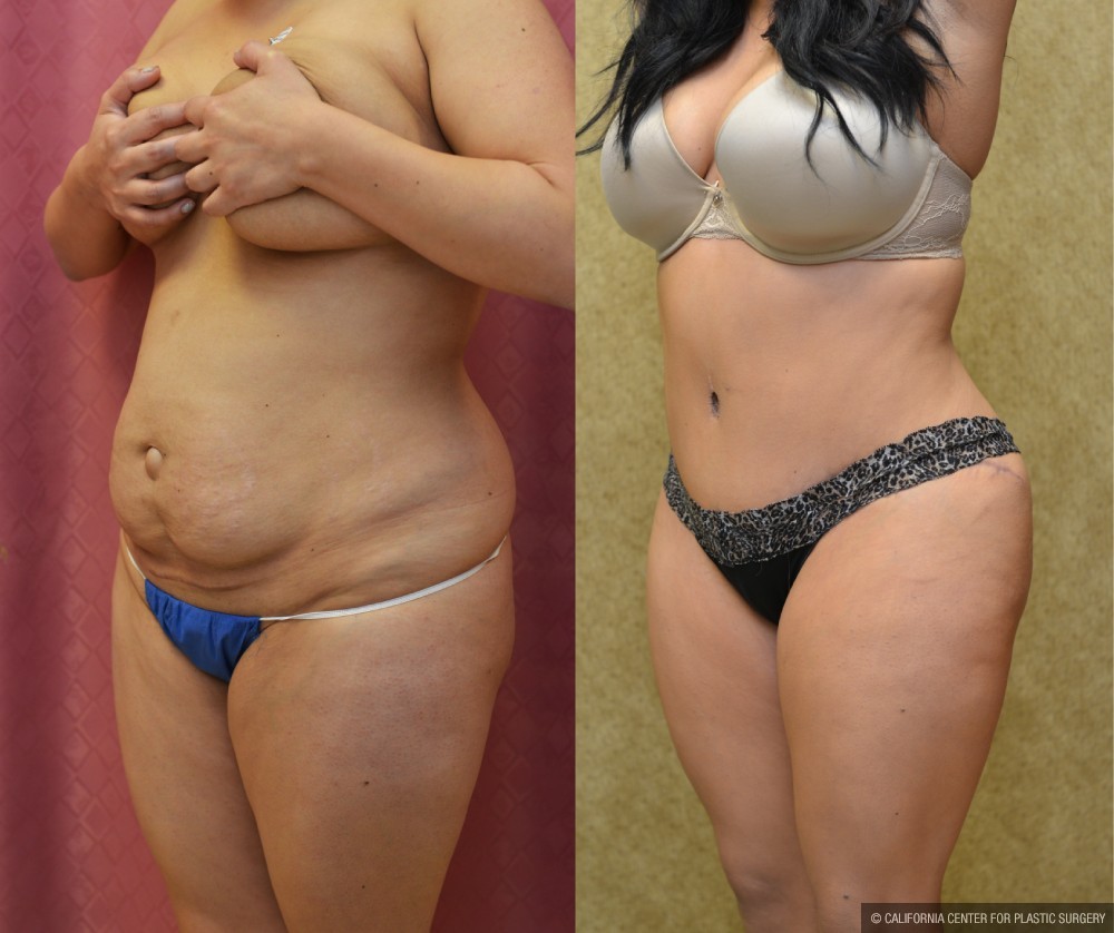 Tummy Tuck (Abdominoplasty) Medium Size Before & After Patient #12638