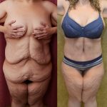 Tummy Tuck (Abdominoplasty) Super Plus Size Before & After Patient #12704