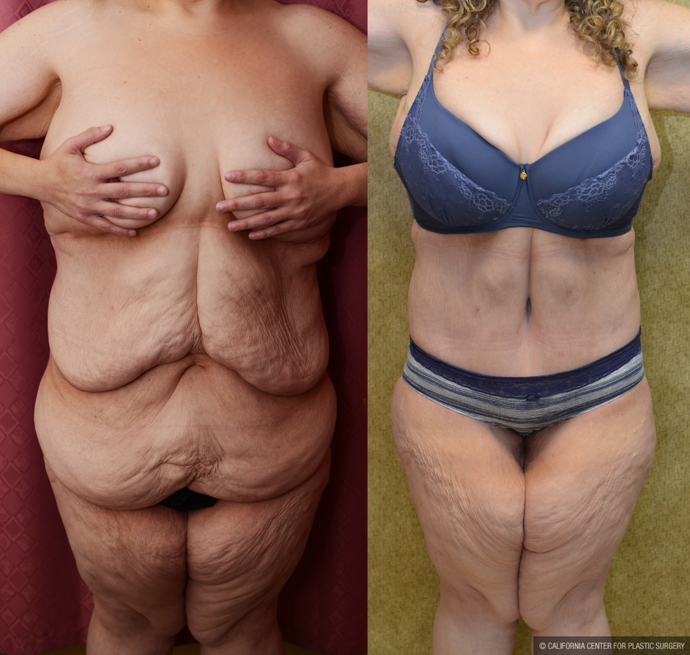 Tummy Tuck (Abdominoplasty) Super Plus Size Before & After Patient #12704