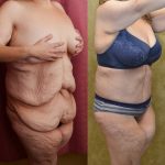 Tummy Tuck (Abdominoplasty) Super Plus Size Before & After Patient #12704