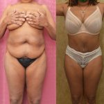 Tummy Tuck (Abdominoplasty) Medium Size Before & After Patient #12646