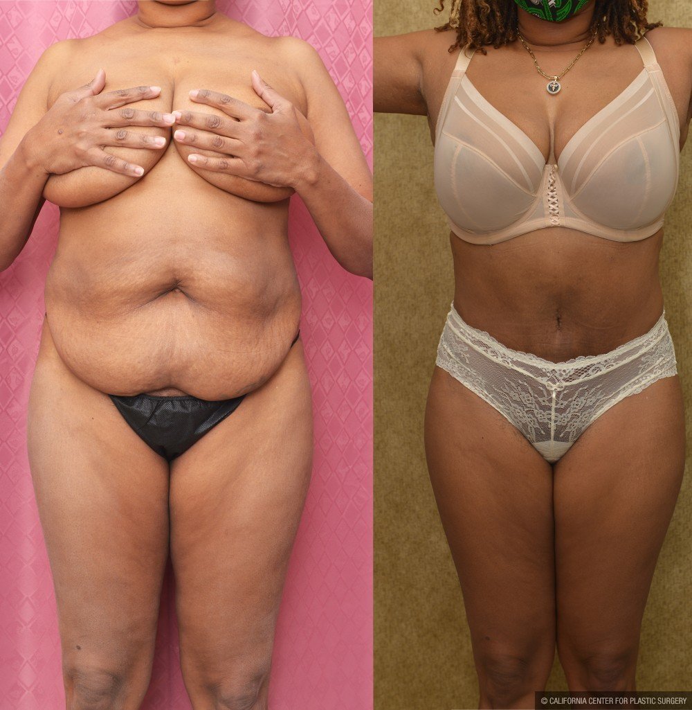 Tummy Tuck (Abdominoplasty) Medium Size Before & After Patient #12646