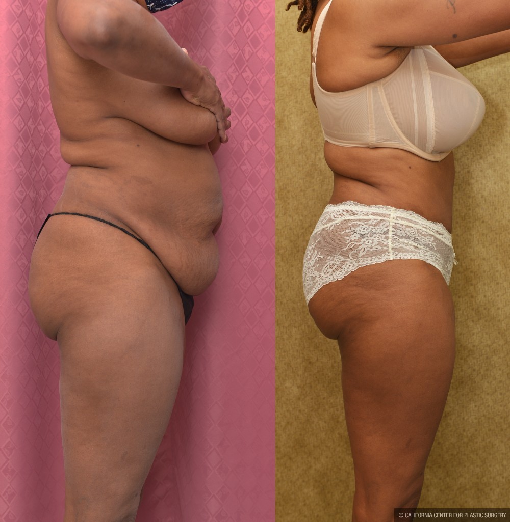 Tummy Tuck (Abdominoplasty) Medium Size Before & After Patient #12646