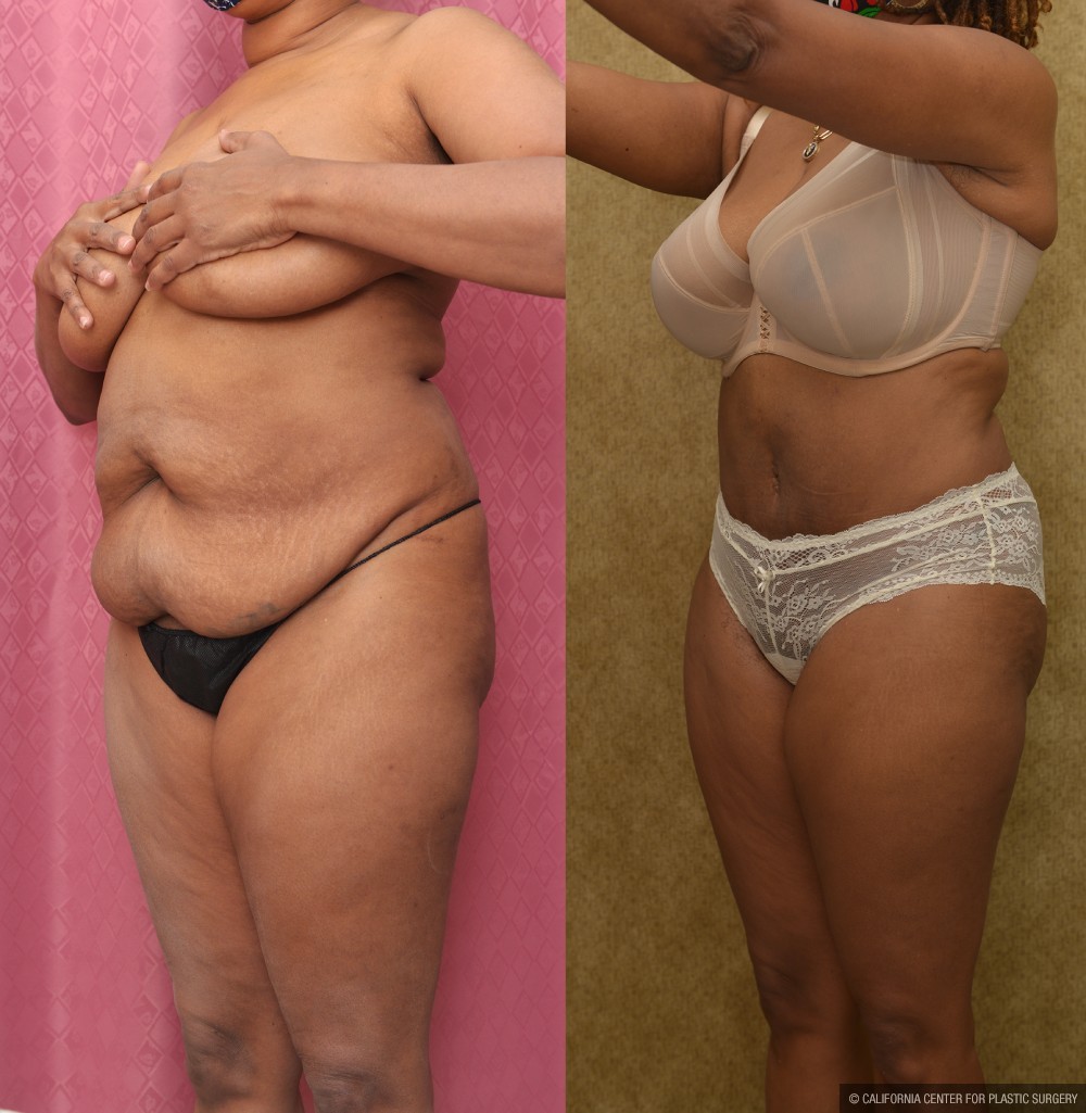 Tummy Tuck (Abdominoplasty) Medium Size Before & After Patient #12646