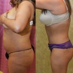 Tummy Tuck (Abdominoplasty) Medium Size Before & After Patient #12626