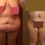 Tummy Tuck (Abdominoplasty) Super Plus Size Before & After Patient #12677