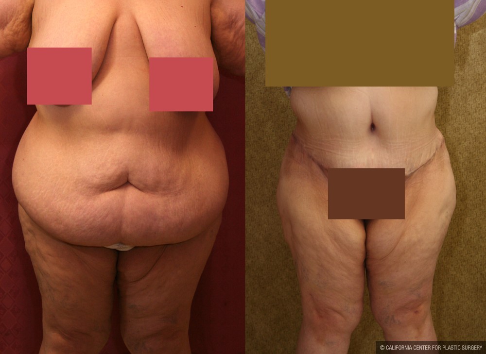 Tummy Tuck (Abdominoplasty) Super Plus Size Before & After Patient #12677